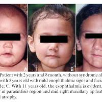 
	Progressive hemifacial atrophy