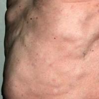 
	Multiple lipomatosis