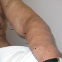 
	Same patient as figure 4

	Arrows denote…