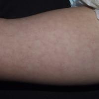 
	Physiological livedo reticularis

	Copied with…