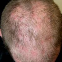 
	Same patient as previous image&nbsp;- scalp…