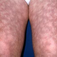 
	Livedo reticularis associated with SLE and the…
