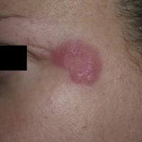 
	Lupus erythematosus tumidus
