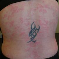 
	Urticarial vasculitis 