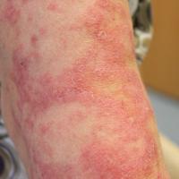 
	Same patient as previous image