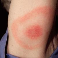 
	Erythema migrans