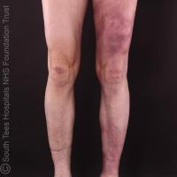 Acrodermatitis chronica atrophicansCopied with…