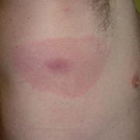
	Erythema migrans