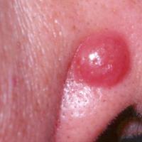 Lymphocytoma cutis