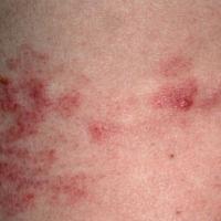 
	Lymphocytoma cutis