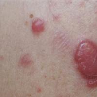 
	Lymphocytoma cutis