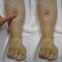 
	Lymphoedema

	Pitting oedema, found in the…