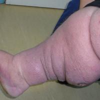 
	Lymphoedema
