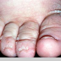 
	Lymphoedema - elephantiasis nostra verrucosa