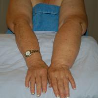 
	Lymphoedema