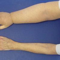 
	Lymphoedema