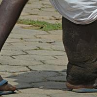 
	Elephantiasis secondary to filariasis