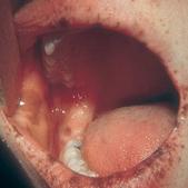 
	Addison's disease