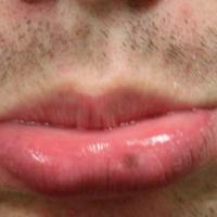 melanotic macule lip treatment Venous Lake of Lip and Lip Freckle Removal with Iridex Laser