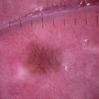oral melanotic macule treatment Mucosal melanocytic macules