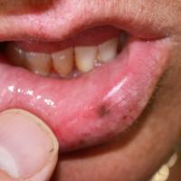 
	Mucosal melanocytic macule