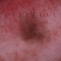 
	Dermoscopic appearance of figure 3