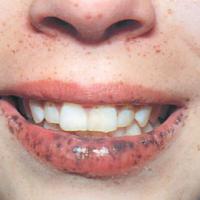
	Peutz-Jeghers syndrome