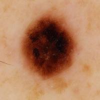 A dermoscopic image of previous figure - prior to…