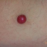 Nodular melanomaAnother EFG. There were no…