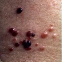 
	Distant skin metastases