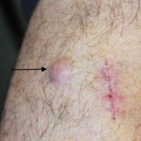 Local skin metastasesThe primary lesion had just…