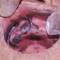 
	Melanoma on the buccal mucosa