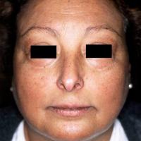 Addison's disease Copied with kind permission…