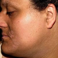 
	Acanthosis nigricans

	Copied with kind…