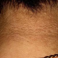 
	Acanthosis nigricans

	Copied with kind…
