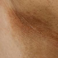 
	Acanthosis nigricans

	Copied with kind…