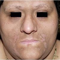 
	Acanthosis nigricans

	Copied with kind…