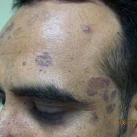 
	Actinic lichen planus