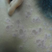 
	Actinic lichen planus