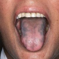 Addison's diseaseCopied with kind permission from…