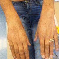 
	Same patient as previous image - UV-exposed…