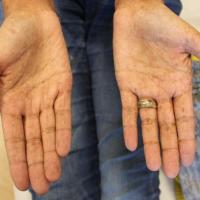 
	Addison's disease -&nbsp;palmar…