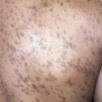 
	Erythema dyschromicum perstans