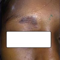 Discoid lupus erythematosus
Copied with kind…