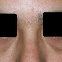 Dark circles under eyes