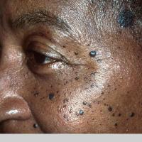 
	Dermatosis papulosa nigra