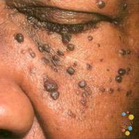Dermatosis papulosis nigra&nbsp;
Copied with…