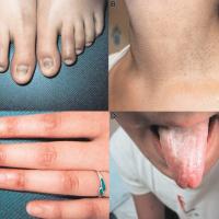 
	Dyskeratosis congenita
