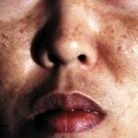 
	Haemochromatosis 

	Involvement of the skin and…