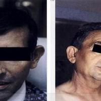 
	Haemochromatosis